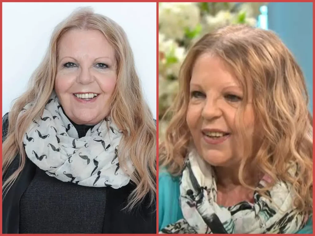 sally thomsett face illness